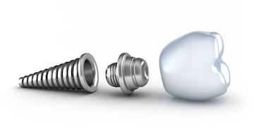 Implant screw and dental crown at Winston Salem dentist office