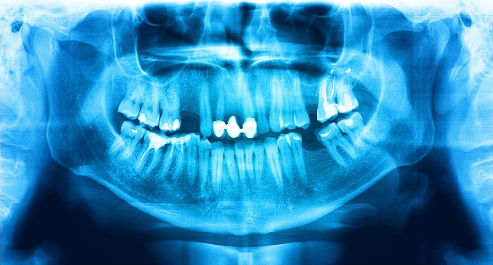 Digital dental x-ray scan at Winston Salem dentist office