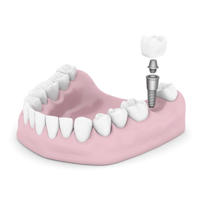 Dental implant screw and crown going into bottom teeth at Winston Salem dentist office