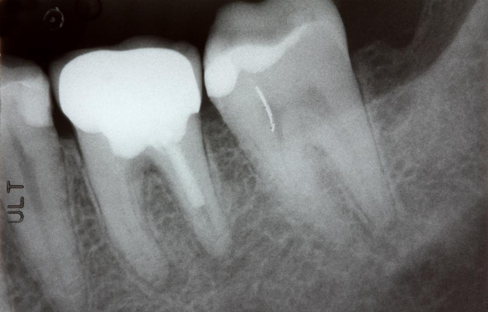 X-Ray Example | Top Dentist 27103