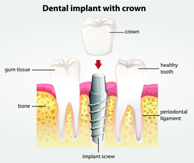 Diagram of a dental implant with crown near 27103