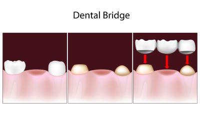 Diagram of a dental bridge in Winston Salem NC