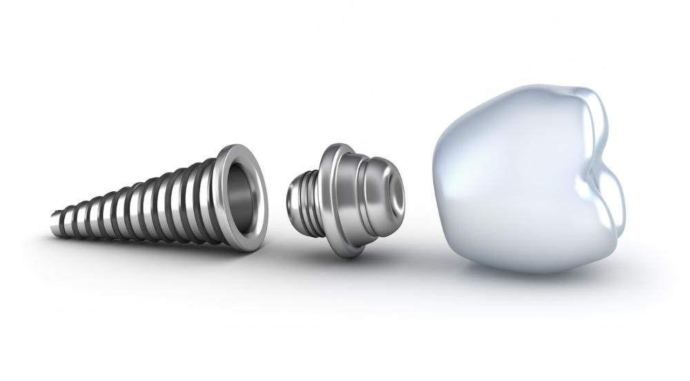 illustration of dental implant and crown