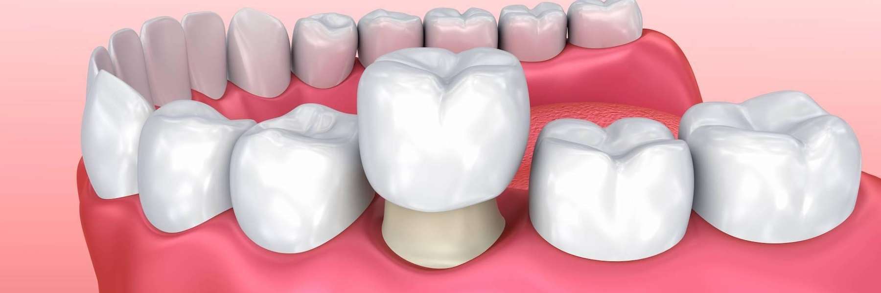 dental crown illustration