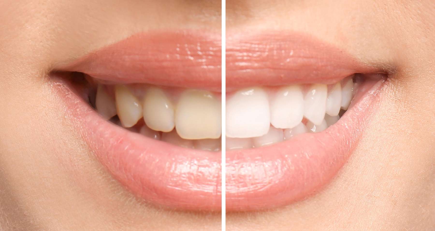 before and after teeth whitening