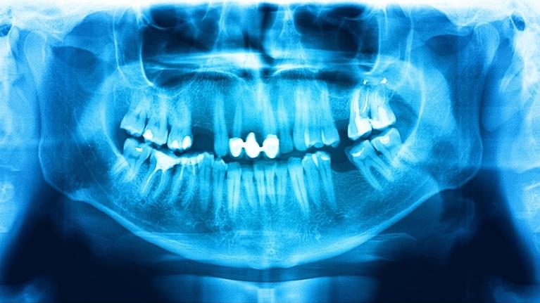 panoramic x-ray example with missing teeth