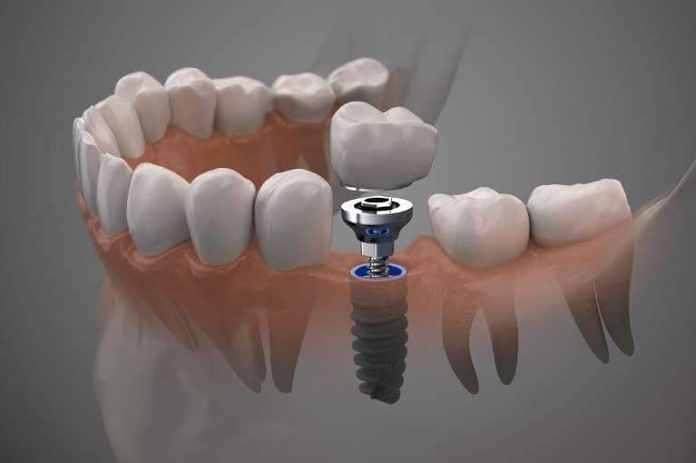 dental implant screw winston salem nc