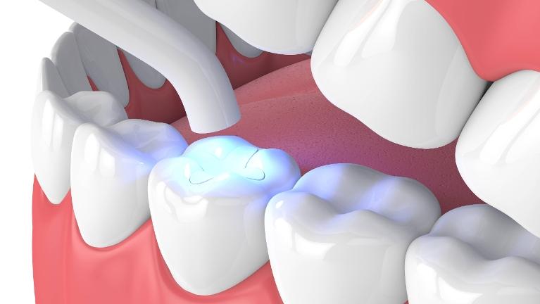graphic of dental filling light