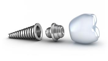 graphic of a dental implant crown and root