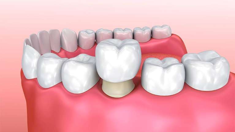 Dental Crown | Protective Cap