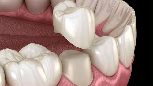 Dental crown placement procedure Winston-Salem NC
