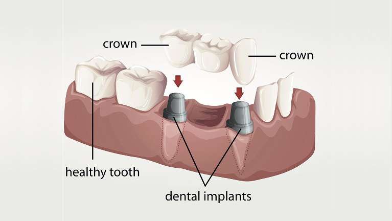 Tooth illustration of dental implants and crowns