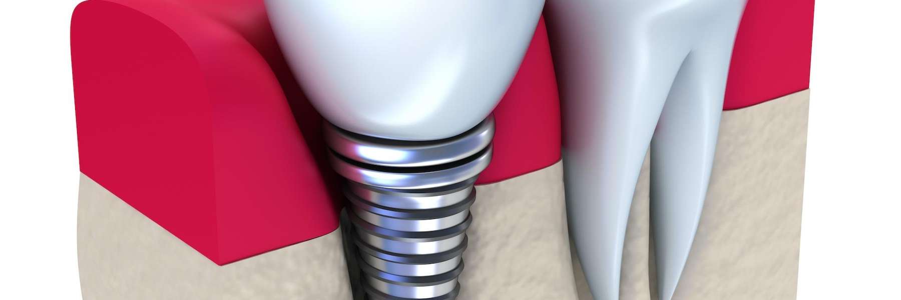 Dental implants illustration - Winston Salem, NC