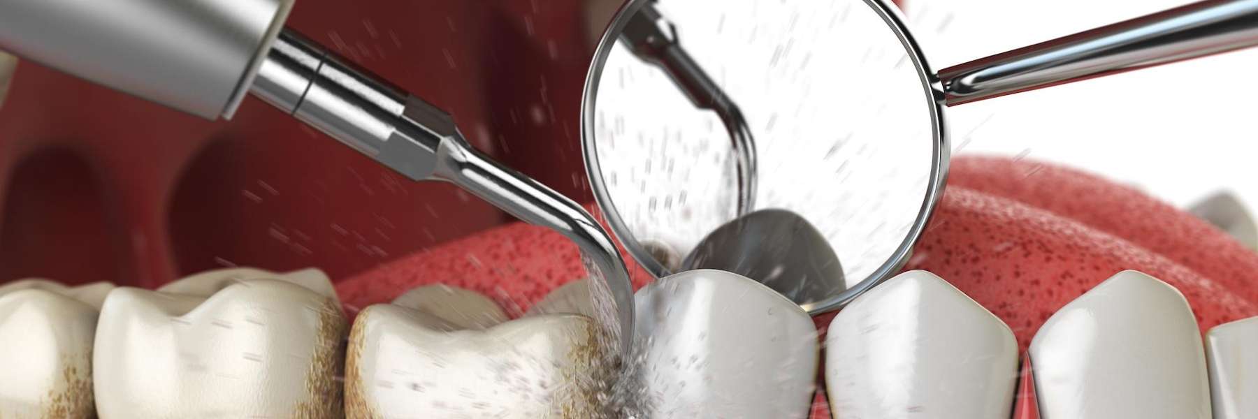 dental cleaning in Winston-Salem, NC