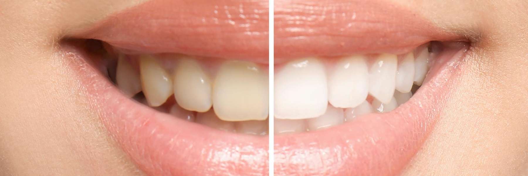 Before and after teeth whitening in Jeffrey J. Tibbs DDS PA