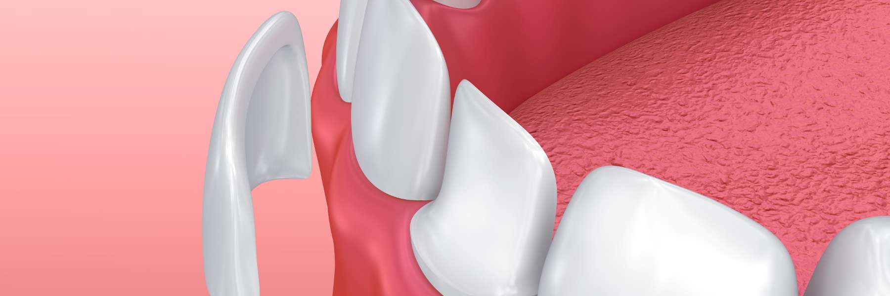 veneers winston salem