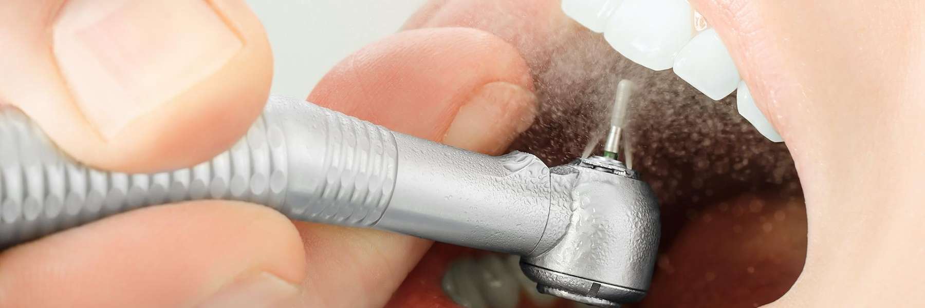 dental fillings winston salem